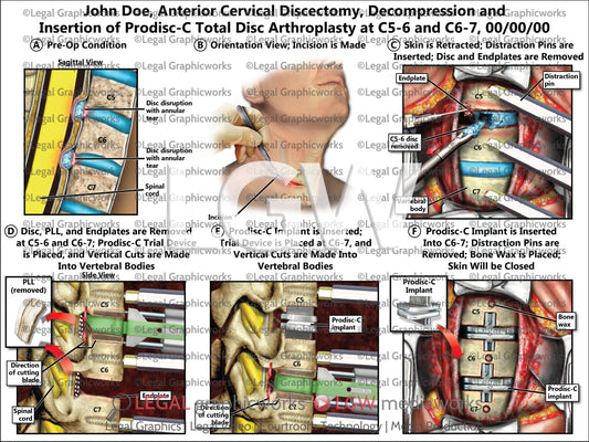 Anterior Cervical Discectomy, Decompression and Insertion of Prodisc-C Total Disc Arthroplasty at C5-6 and C6-7