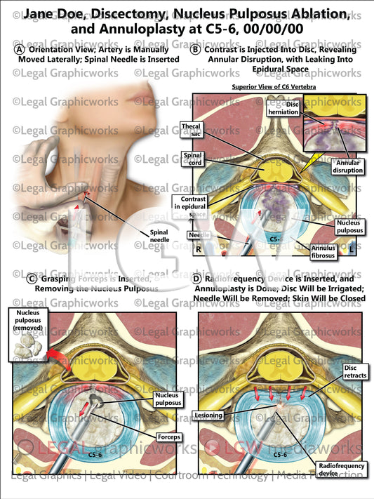 Discectomy, Nucleus Pulposus Ablation, and Annuloplasty at C5-6