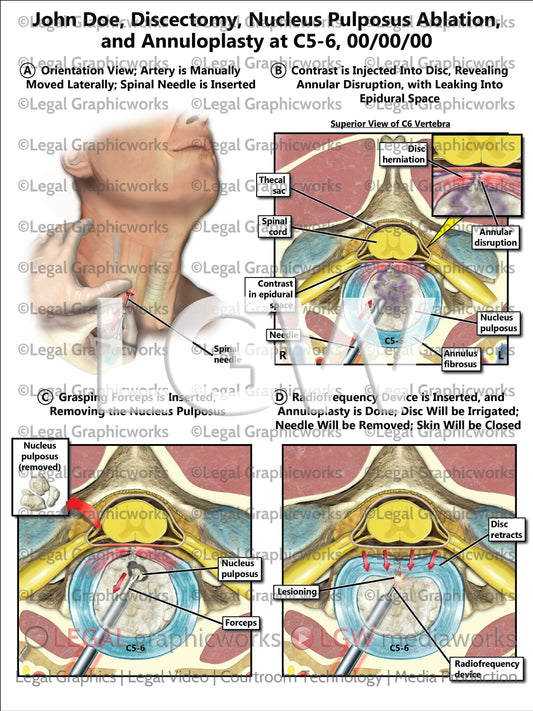 Discectomy, Nucleus Pulposus Ablation, and Annuloplasty at C5-6