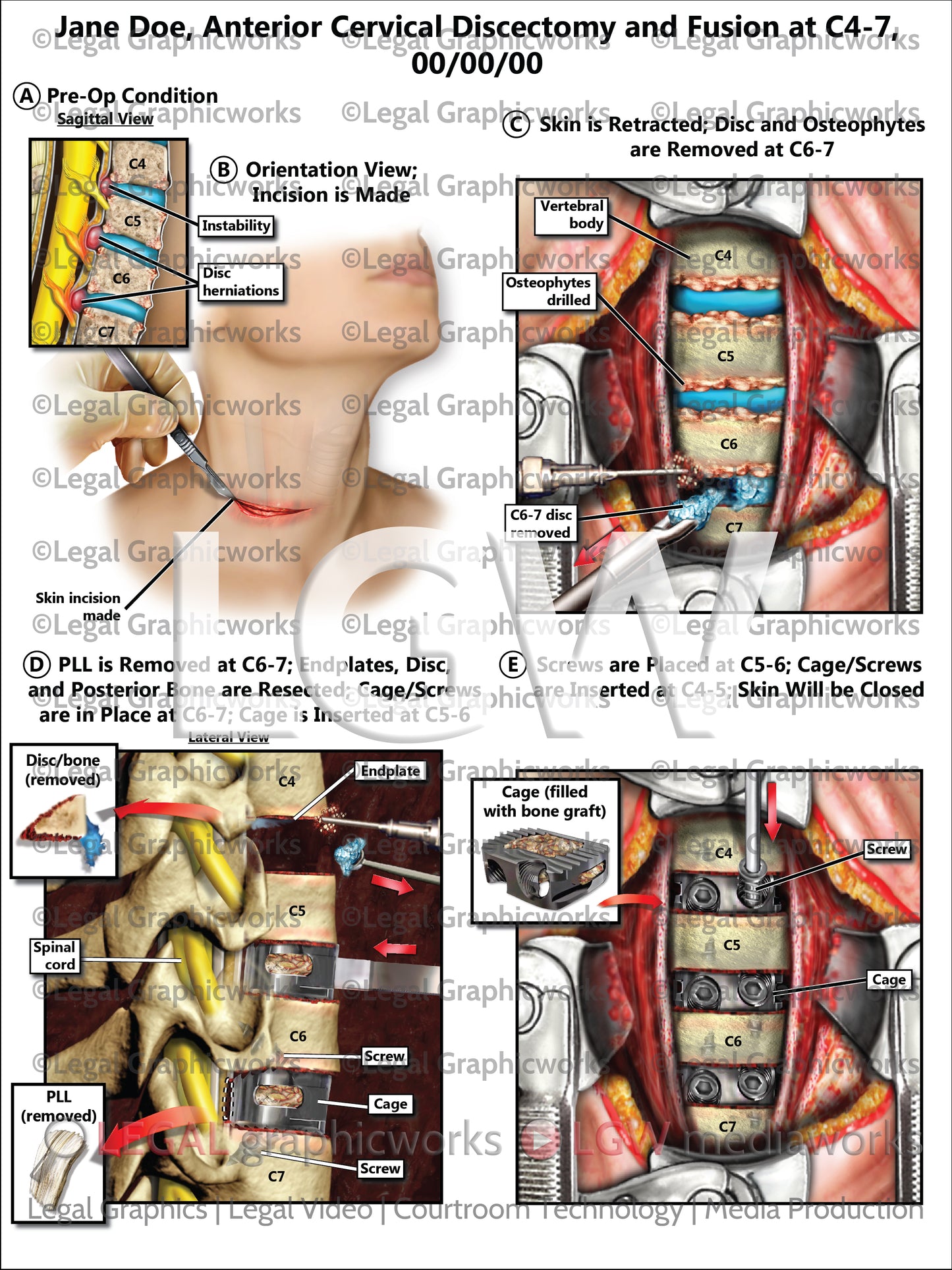 Anterior Cervical Discectomy and Fusion at C4-7