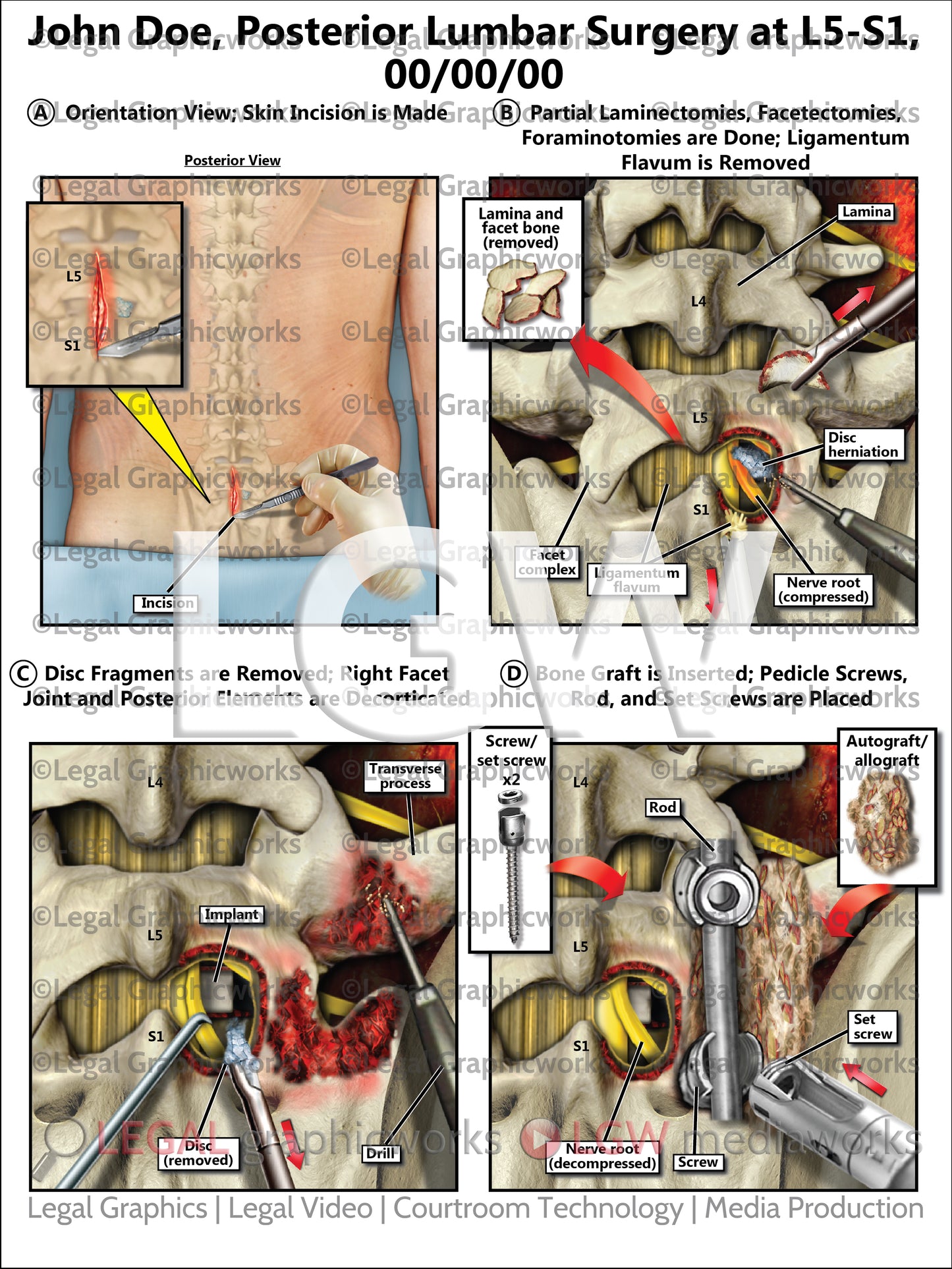 Posterior Lumbar Surgery at L5-S1