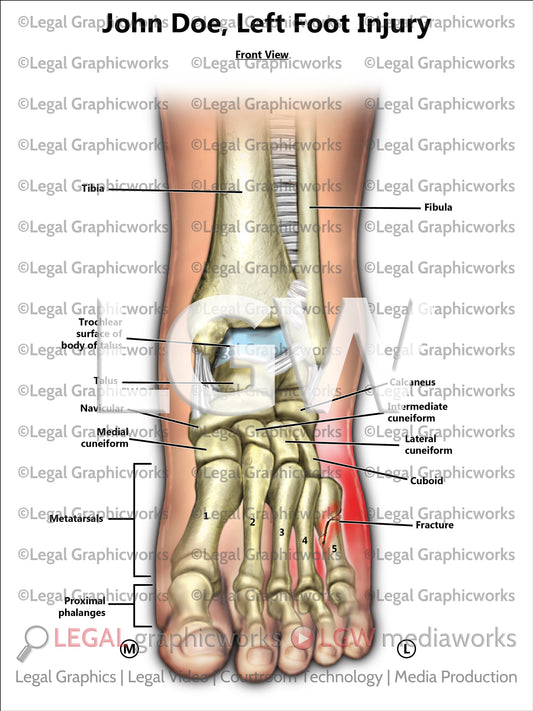 Left Foot Injury