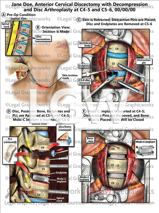 Anterior Cervical Discectomy with Decompression and Disc Arthroplasty at C4-5 and C5-6