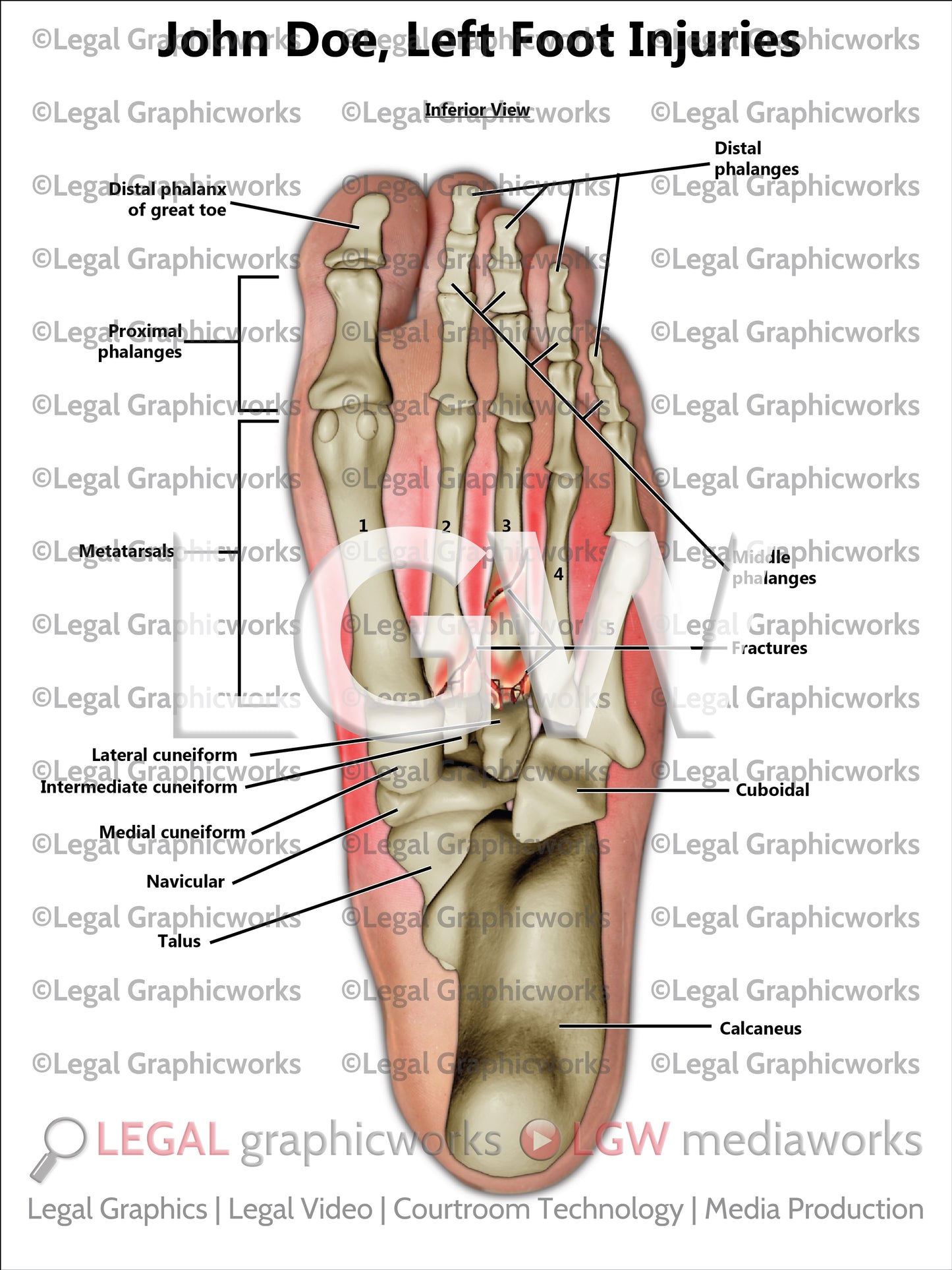 Left Foot Injuries