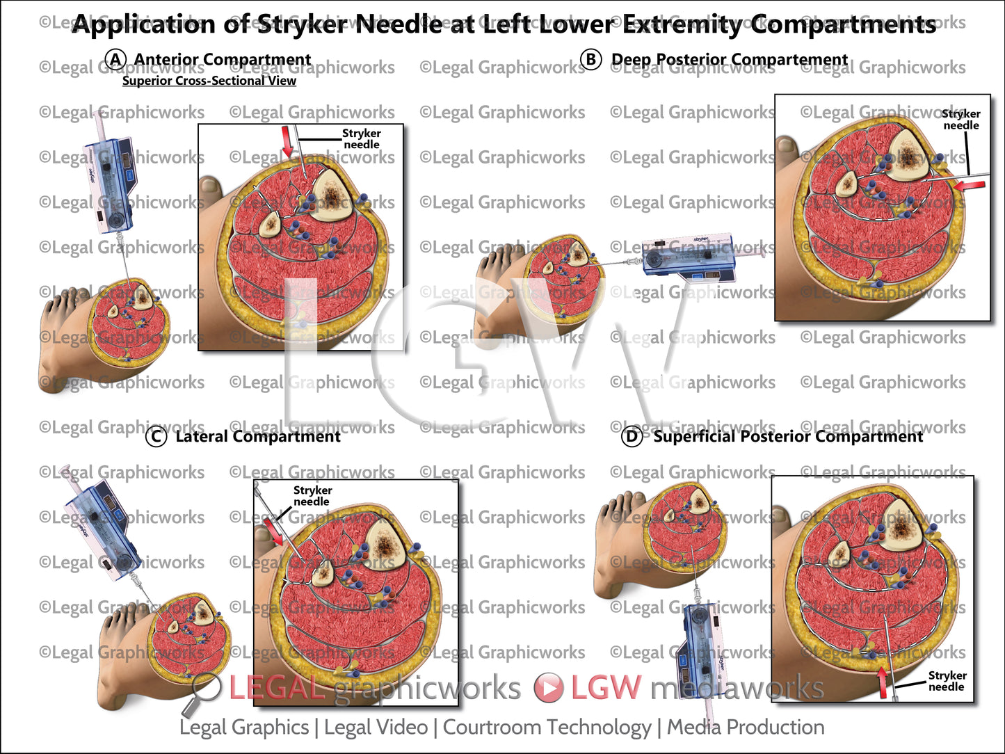 Application of Stryker Needle at Left Lower Extremity Compartments