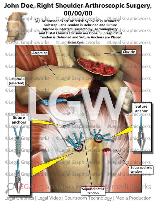 Right Shoulder Arthroscopic Surgery