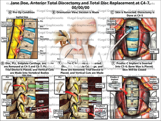 Anterior Total Discectomy and Total Disc Replacement at C4-7