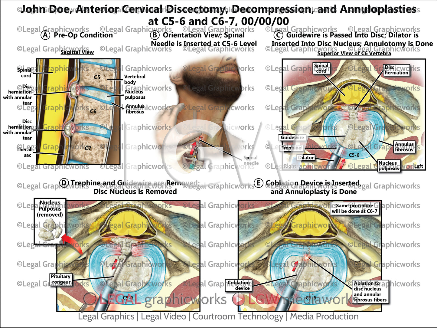 Anterior Cervical Discectomy, Decompression, and Annuloplasties at C5-6 and C6-7