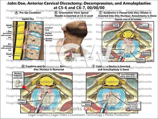 Anterior Cervical Discectomy, Decompression, and Annuloplasties at C5-6 and C6-7