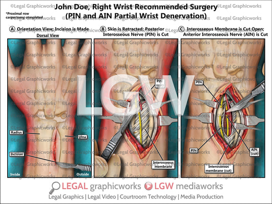 Right Wrist Recommended Surgery (PIN and AIN Partial Wrist Denervation)