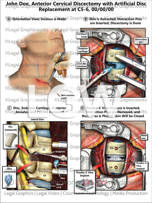 Anterior Cervical Discectomy with Artificial Disc Replacement at C5-6