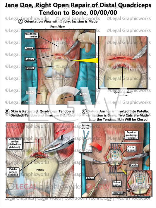 Right Open Repair of Distal Quadriceps Tendon to Bone