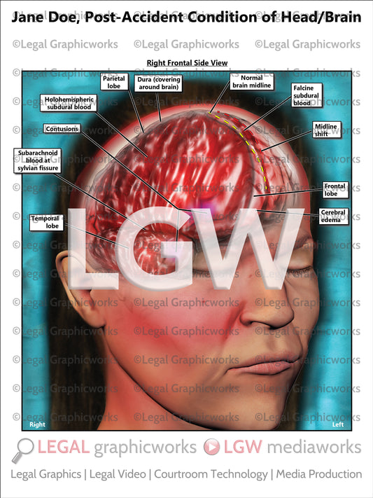Post-Accident Condition of Head/Brain