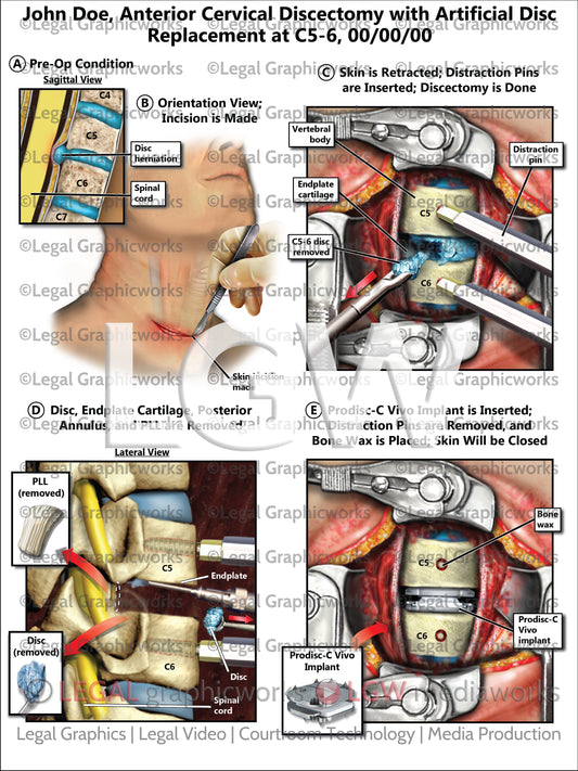 Anterior Cervical Discectomy with Artificial Disc Replacement at C5-6