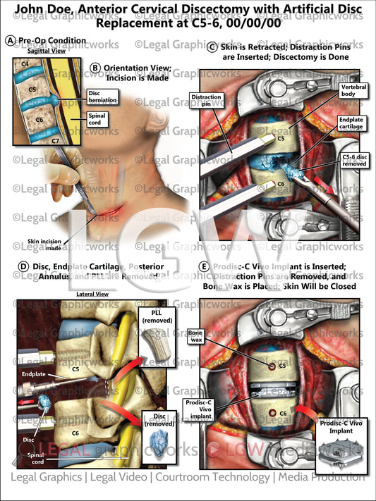 Anterior Cervical Discectomy with Artificial Disc Replacement at C5-6
