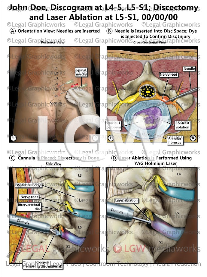 Discogram Approach Discogram at L4-5, L5-S1; Discectomy and Laser Ablation at L5-S1 – LGWgo