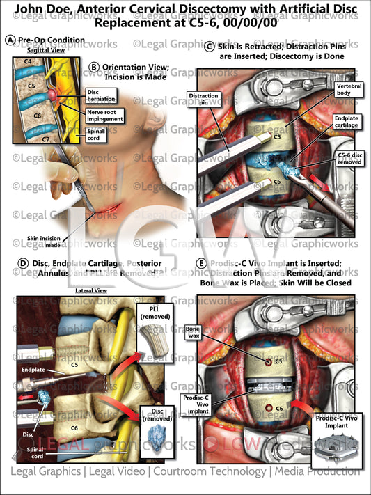 Anterior Cervical Discectomy with Artificial Disc Replacement at C5-6