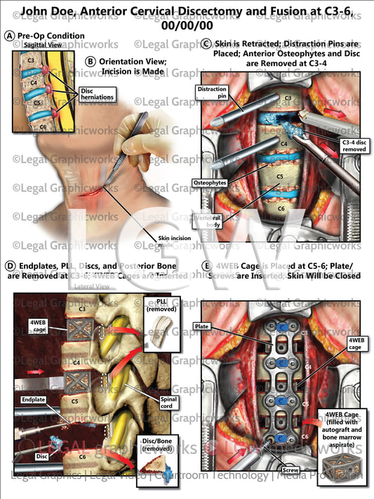 Anterior Cervical Discectomy and Fusion at C3-6