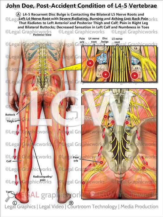 Post-Accident Condition of L4-5 Vertebrae