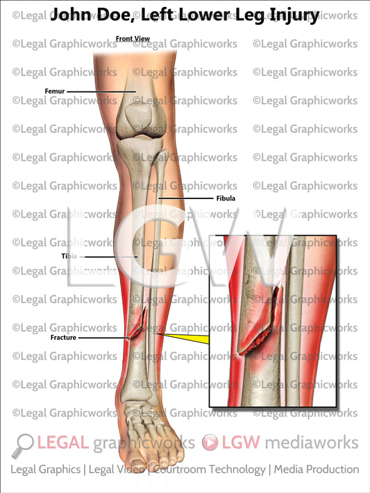 Left Lower Leg Injury