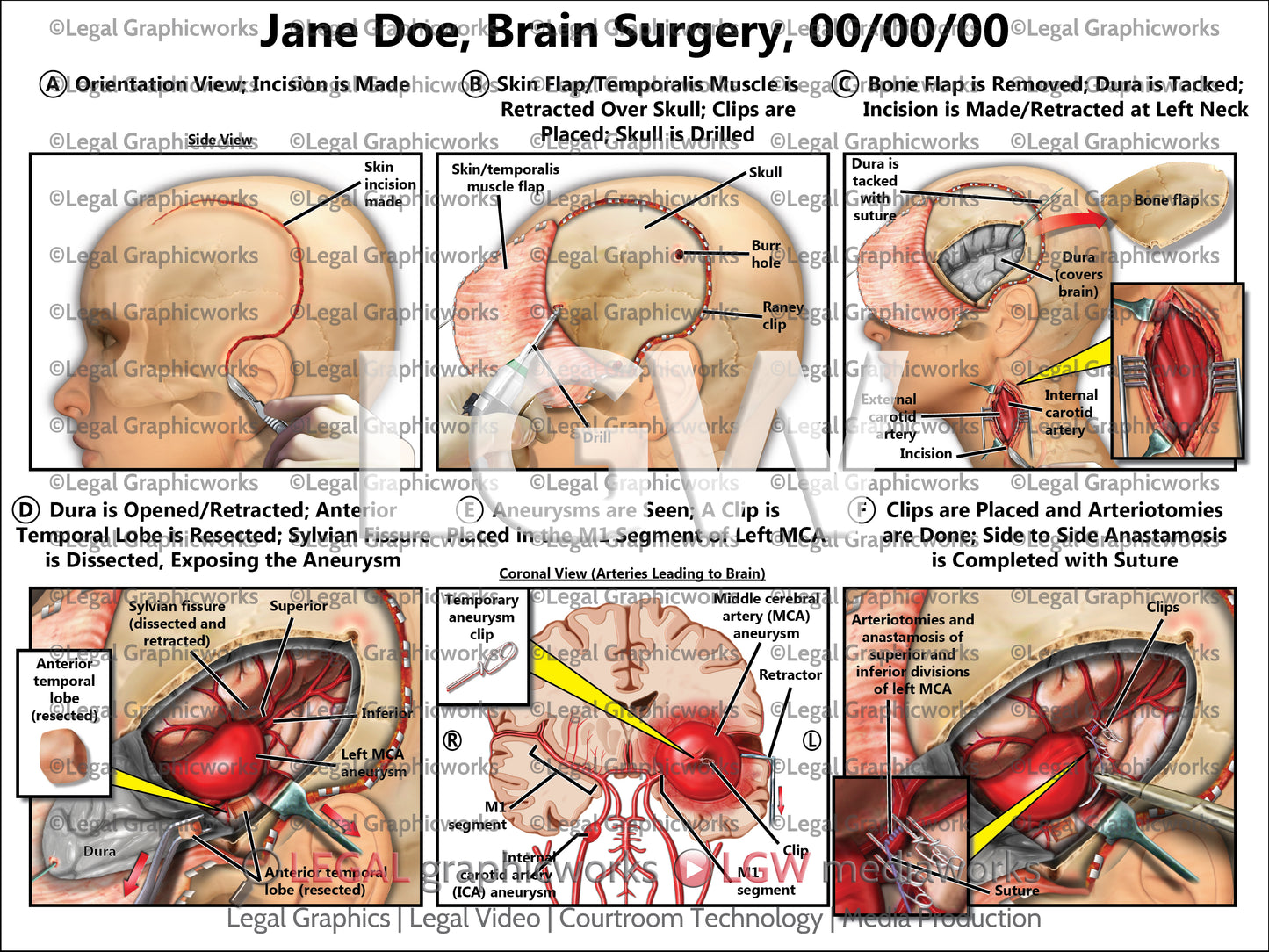 Brain Surgery