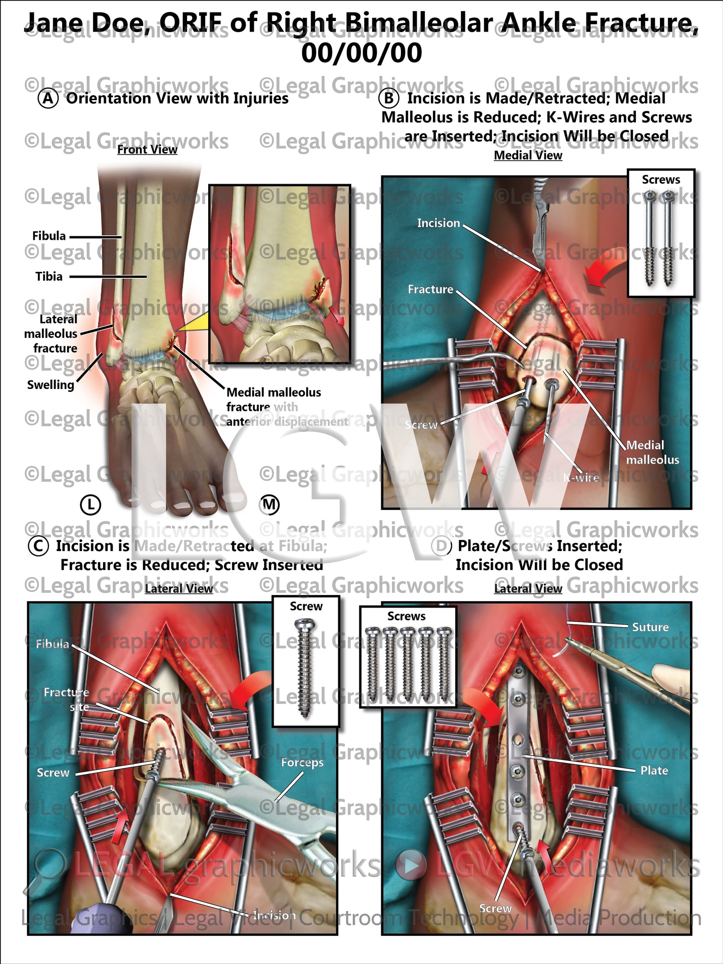 ORIF of Right Bimalleolar Ankle Fracture