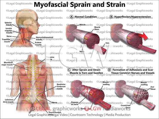Myofascial Sprain and Strain