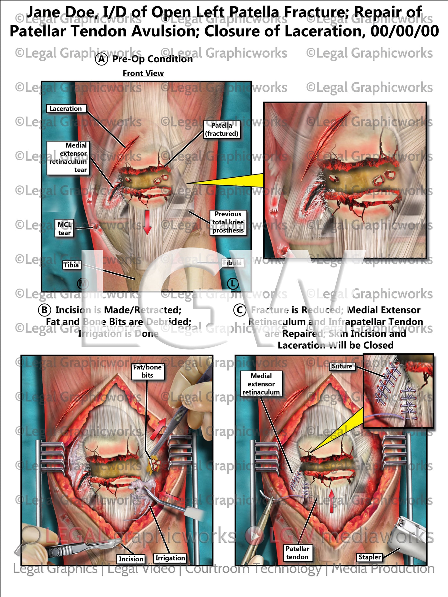 I/D of Open Left Patella Fracture; Repair of Patellar Tendon Avulsion; Closure of Laceration