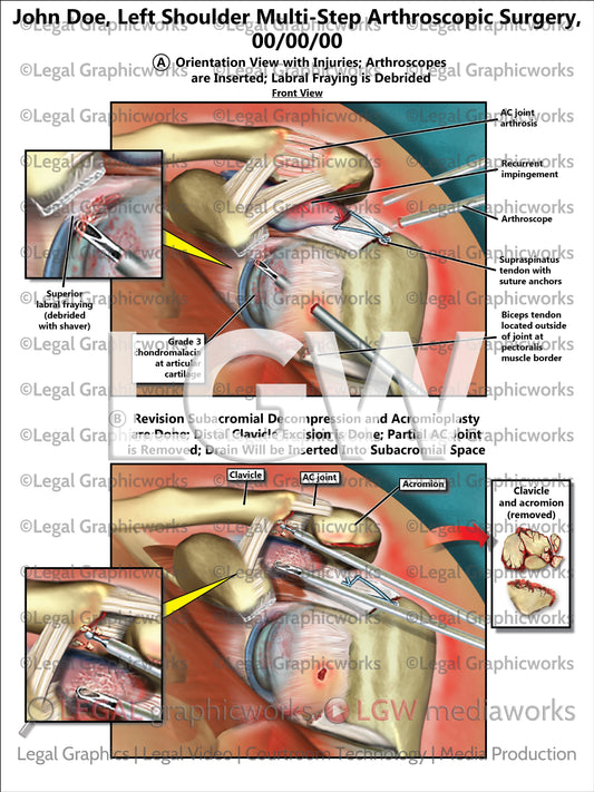 Left Shoulder Multi-Step Arthroscopic Surgery