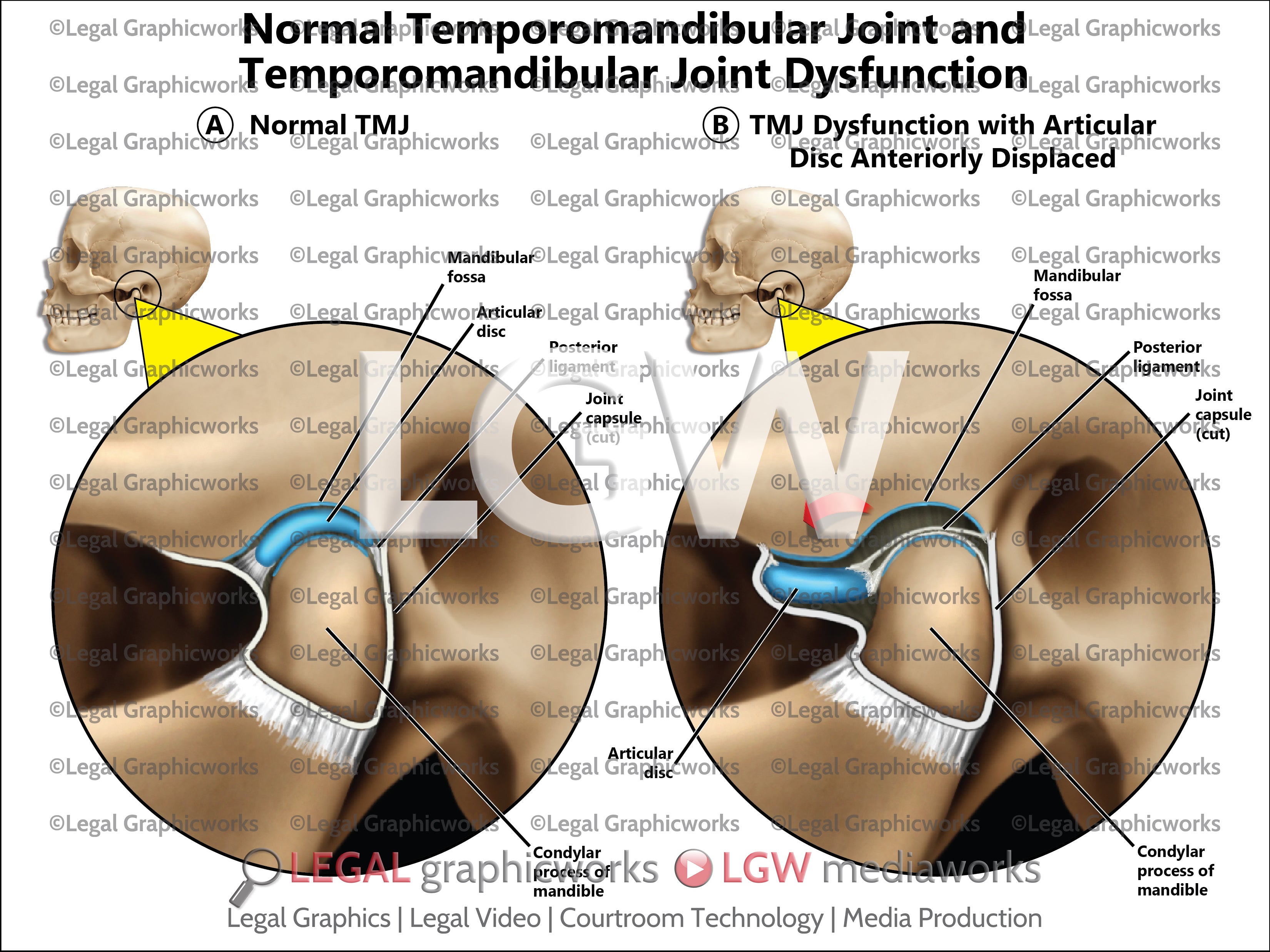 Normal Temporomandibular Joint and Temporomandibular Joint Dysfunction ...