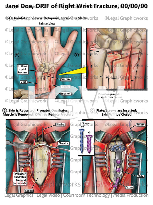 ORIF of Right Wrist Fracture