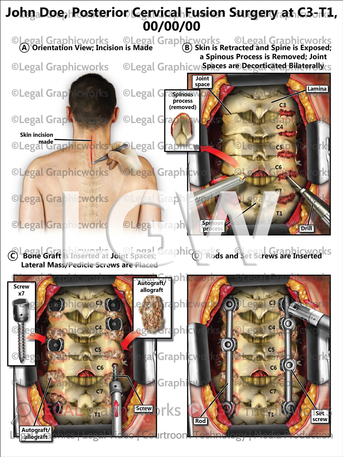 Posterior Cervical Fusion Surgery at C3-T1