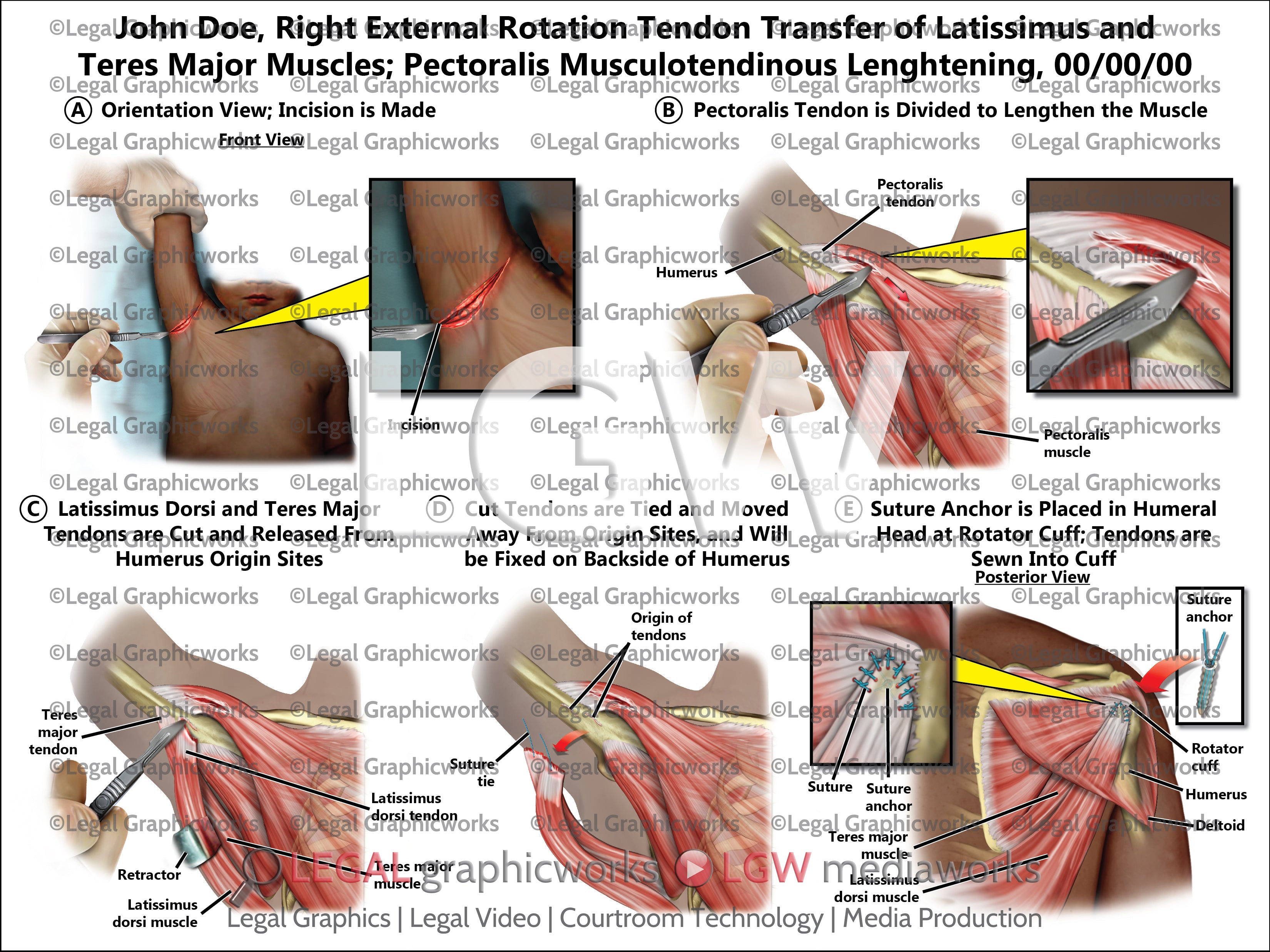 Forearm Rotation Tendon Right External Rotation Tendon Transfer of Latissimus and Teres Major ...