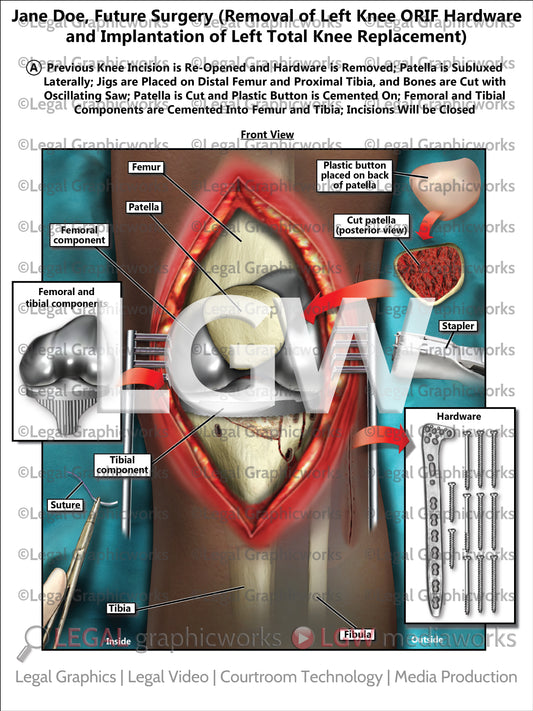 Future Surgery (Removal of Left Knee ORIF Hardware and Implantation of Left Total Knee Replacement)