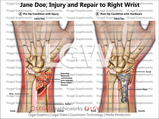 Injury and Repair to Right Wrist