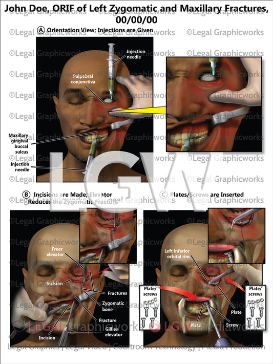 ORIF of Left Zygomatic and Maxillary Fractures