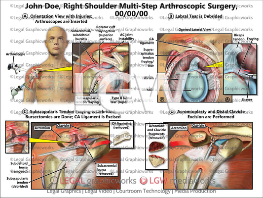 Right Shoulder Multi-Step Arthroscopic Surgery