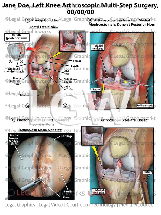 Left Knee Arthroscopic Multi-Step Surgery