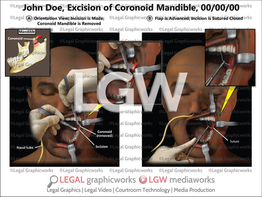 Excision of Coronoid Mandible
