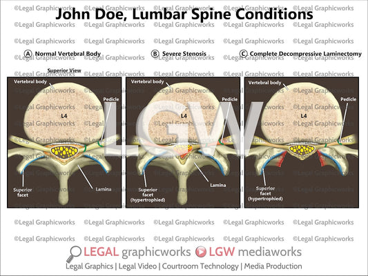 Lumbar Spine Conditions