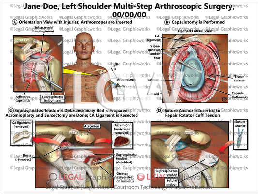 Left Shoulder Multi-Step Arthroscopic Surgery