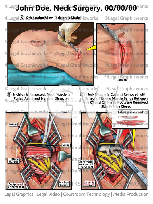 Neck Surgery