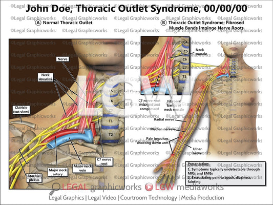 Thoracic Outlet Syndrome