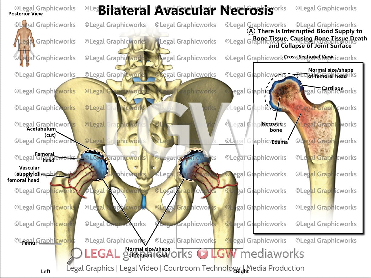 Bilateral Avascular Necrosis