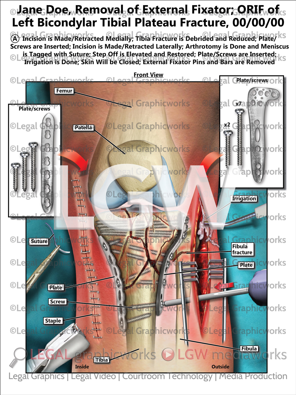 External Fixation Open Tibia Removal of External Fixator; ORIF of Left Bicondylar Tibial Plateau Fr ...