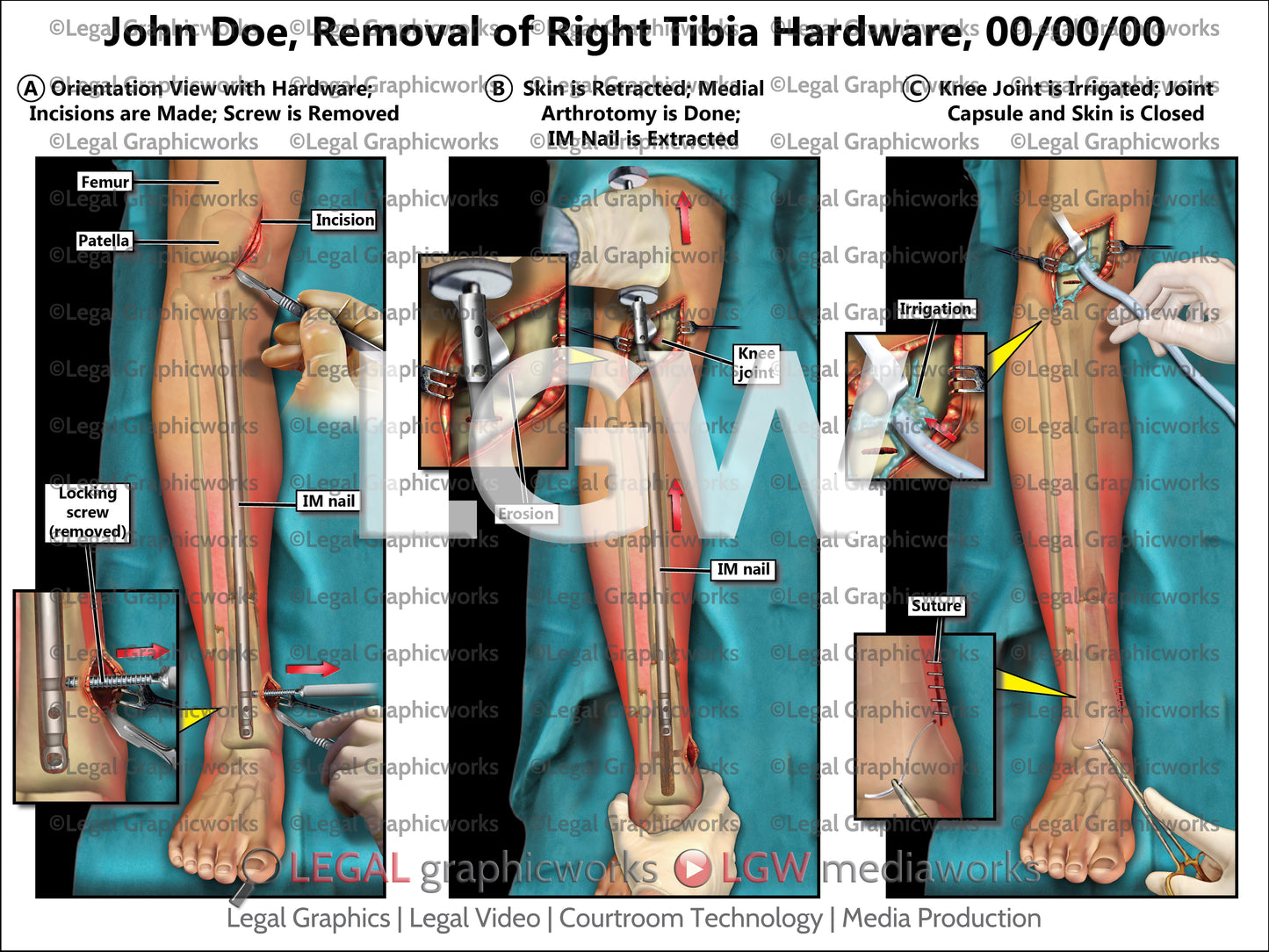 Removal of Right Tibia Hardware