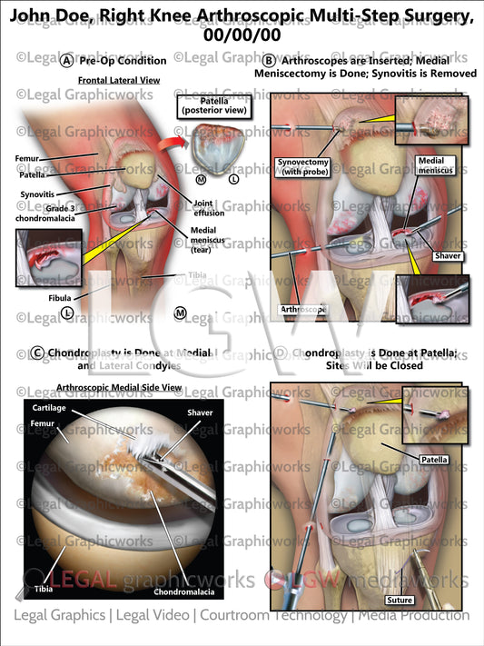 Right Knee Arthroscopic Multi-Step Surgery