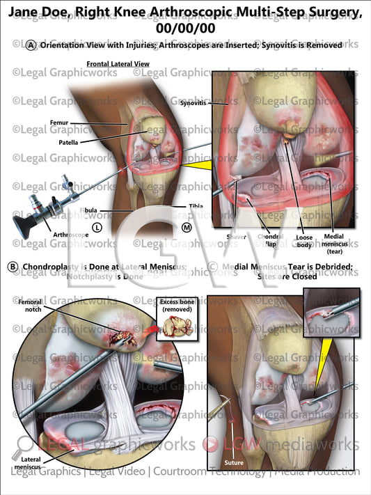 Right Knee Arthroscopic Multi-Step Surgery