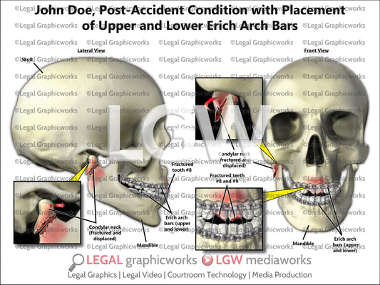 Post-Accident Condition with Placement of Upper and Lower Erich Arch Bars