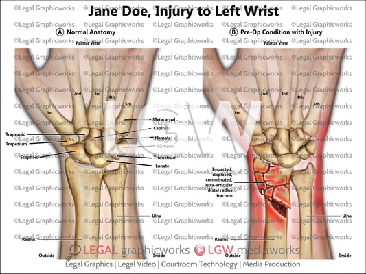 Injury to Left Wrist
